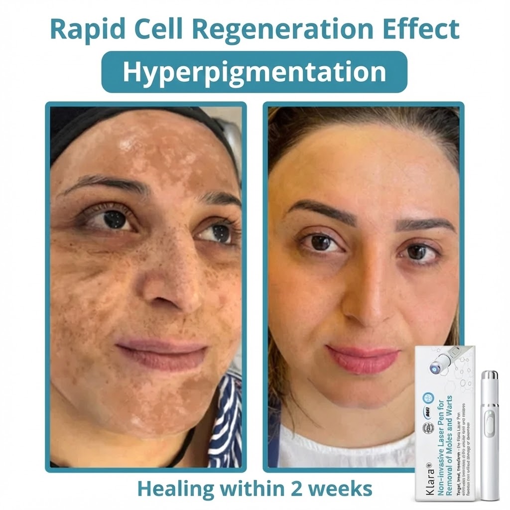 Klara® Pain-Free Laser Pen for Removing Moles and Warts – Promax Edition