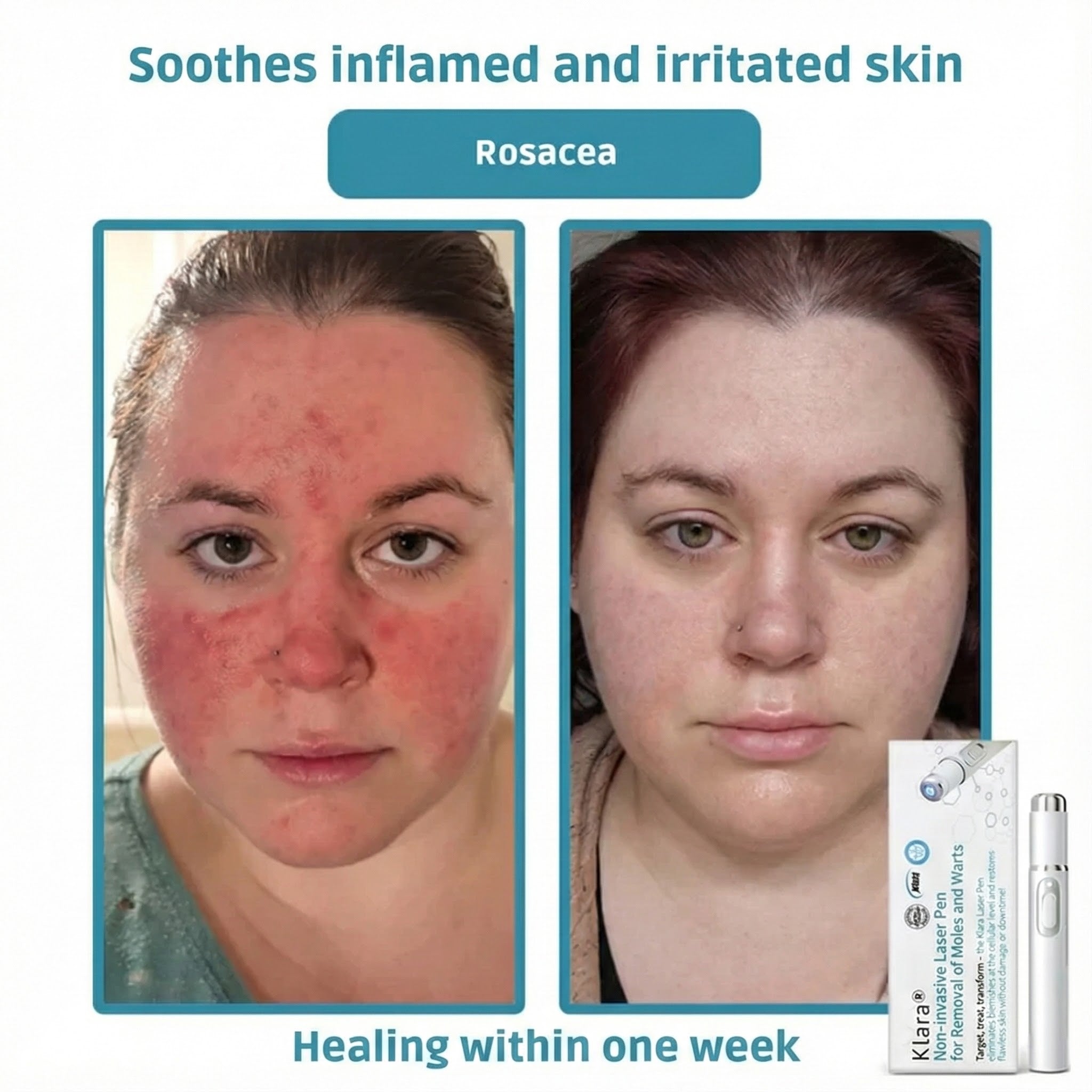 Klara® Pain-Free Laser Pen for Removing Moles and Warts – Promax Edition