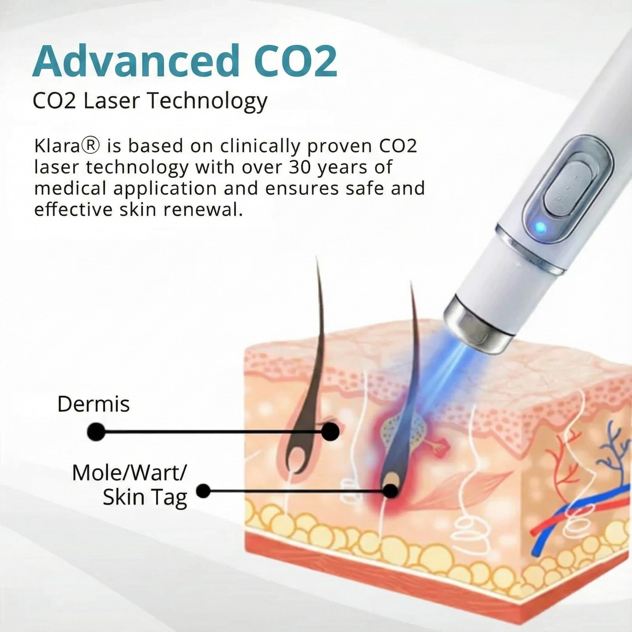 Klara® Pain-Free Laser Pen for Removing Moles and Warts – Promax Edition