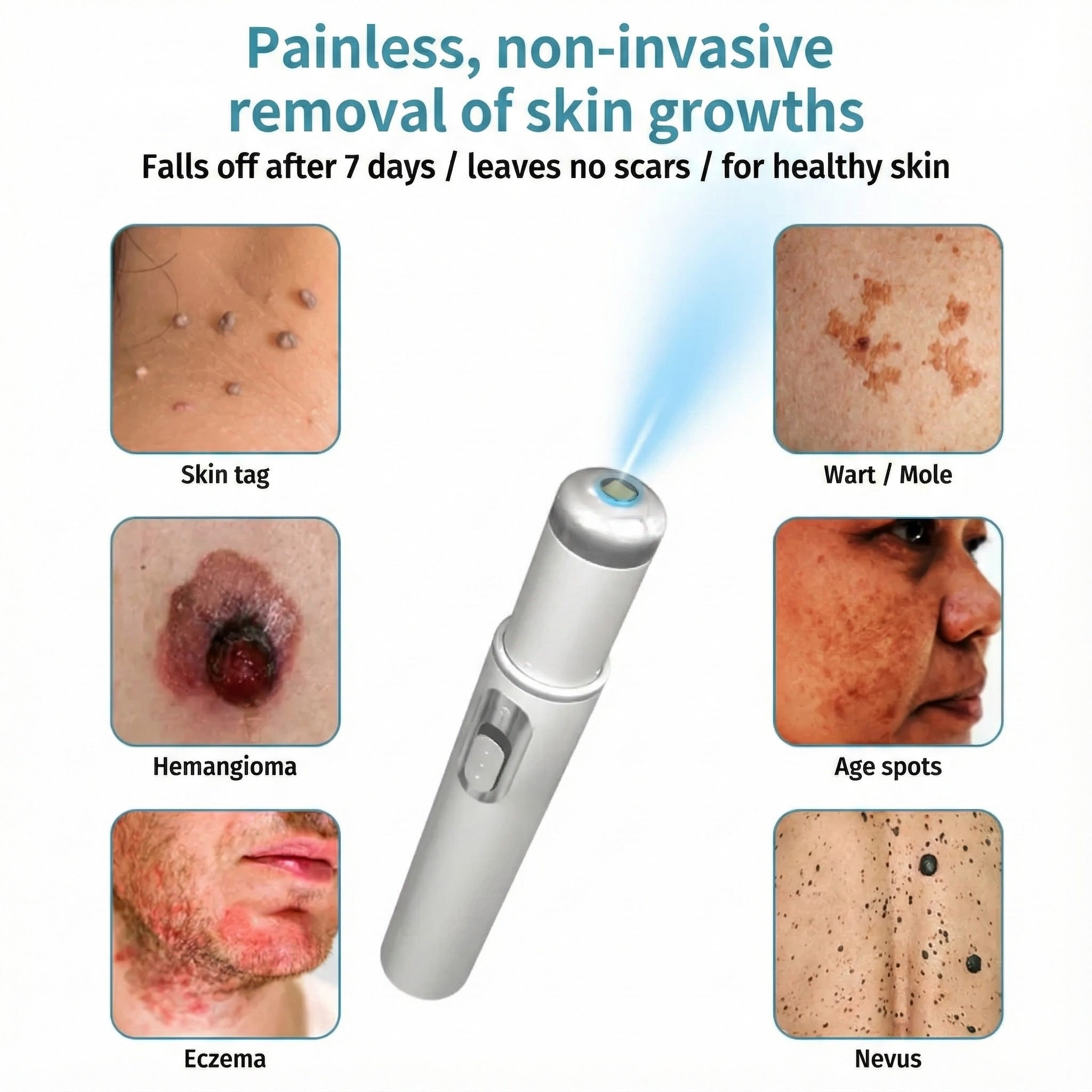 Klara® Pain-Free Laser Pen for Removing Moles and Warts – Promax Edition