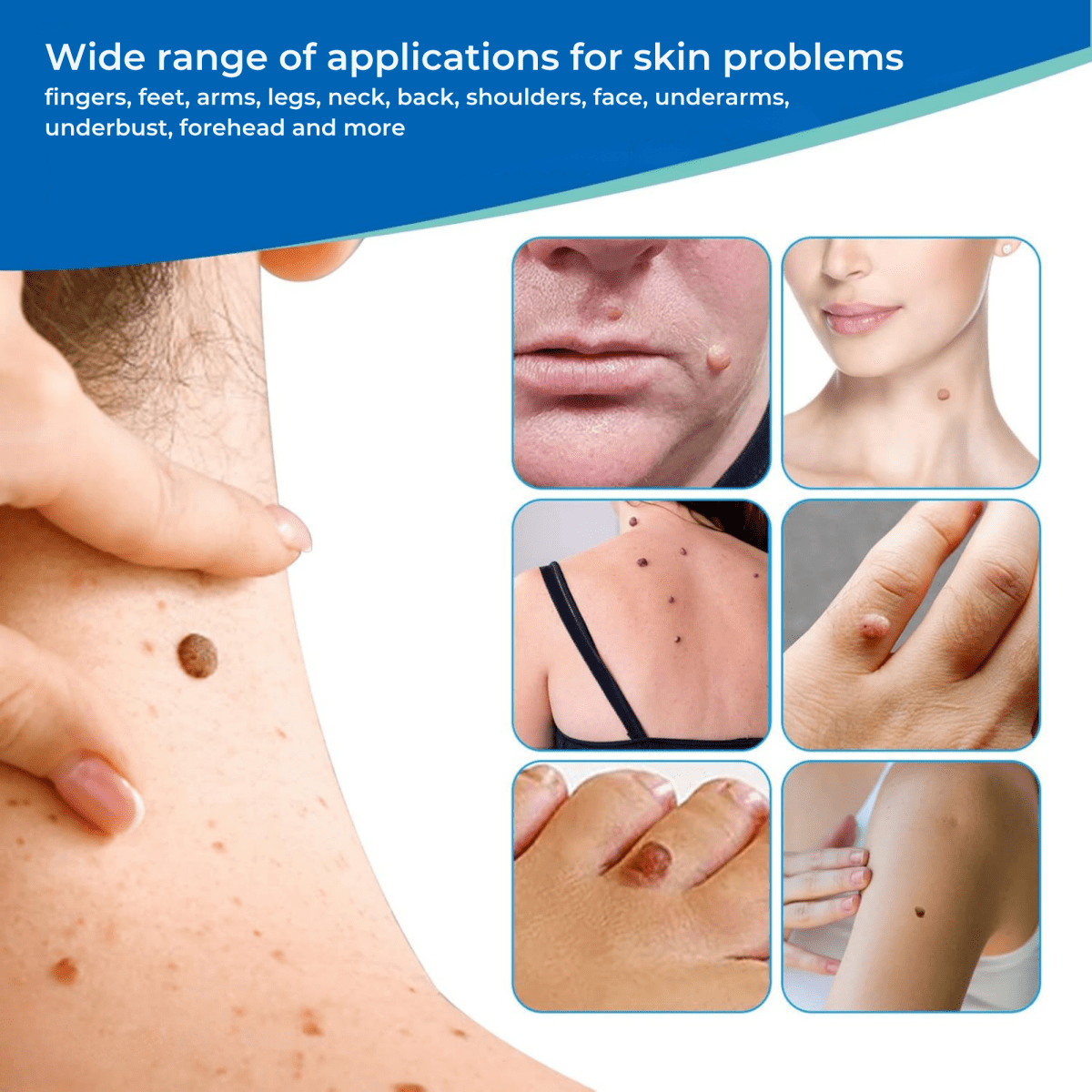 DermaFix – Wart Remover Pen - Lovitzo