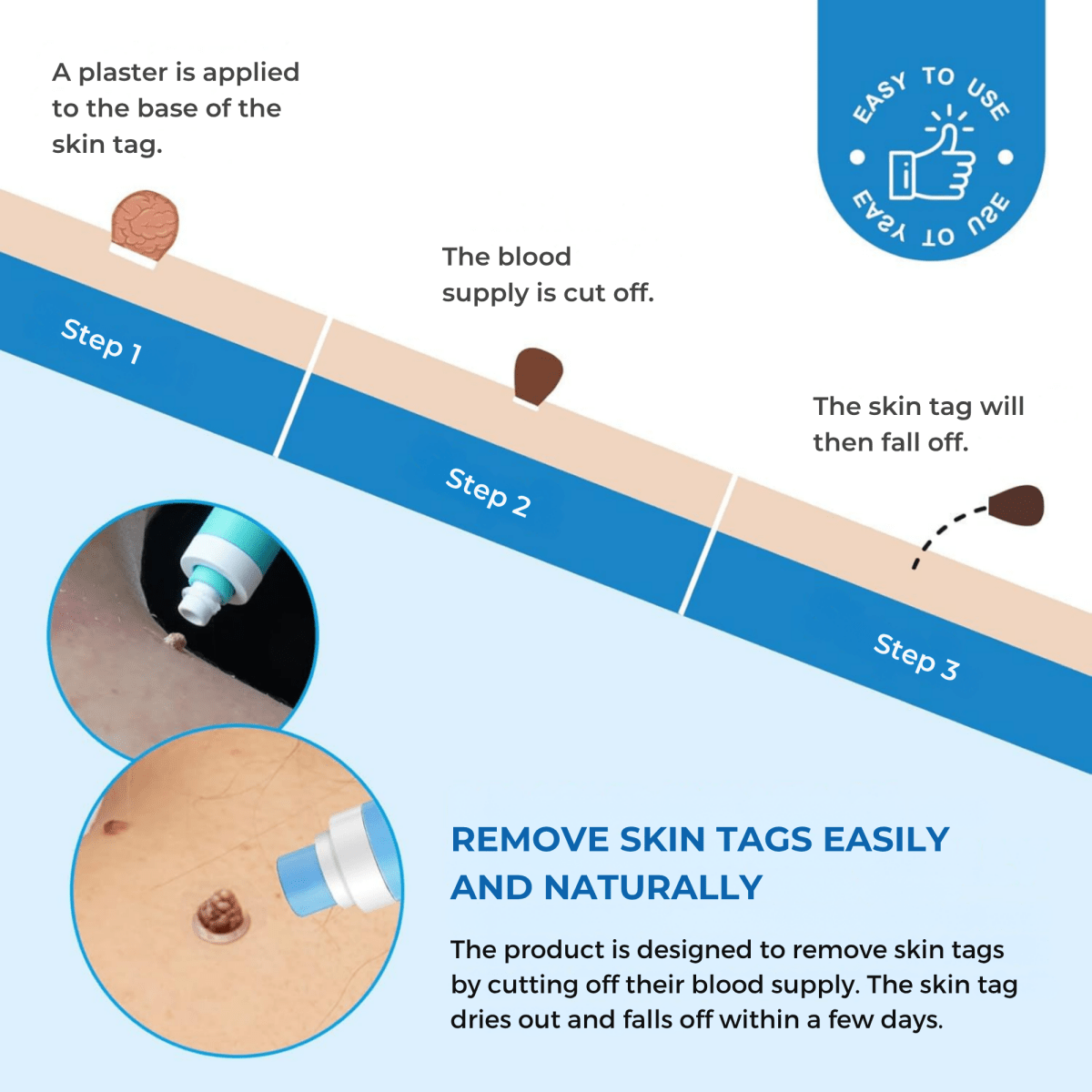 DermaFix – Wart Remover Pen - Lovitzo