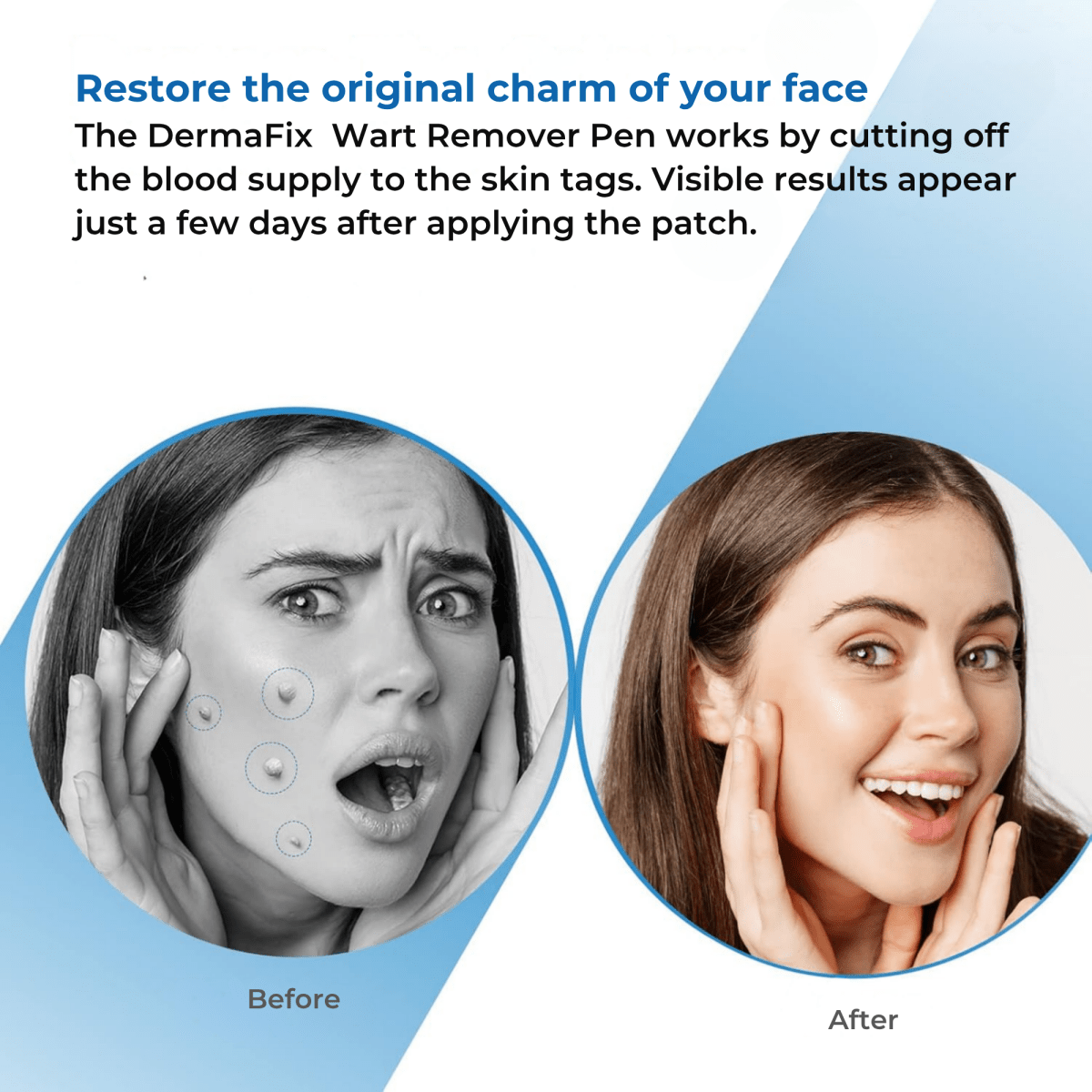 DermaFix – Wart Remover Pen - Lovitzo