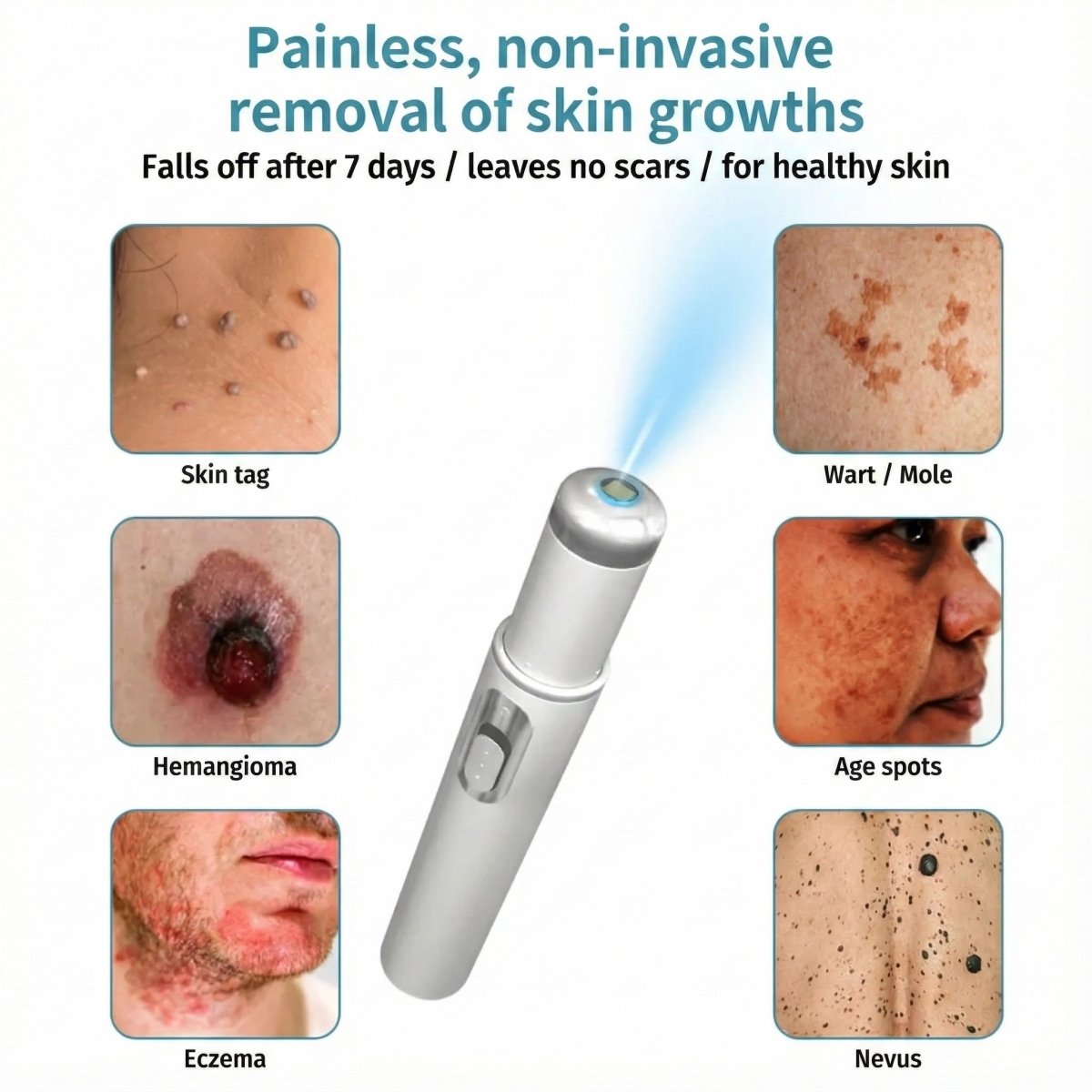 Klara® Pain - Free Laser Pen for Removing Moles and Warts – Promax Edition - Lovitzo