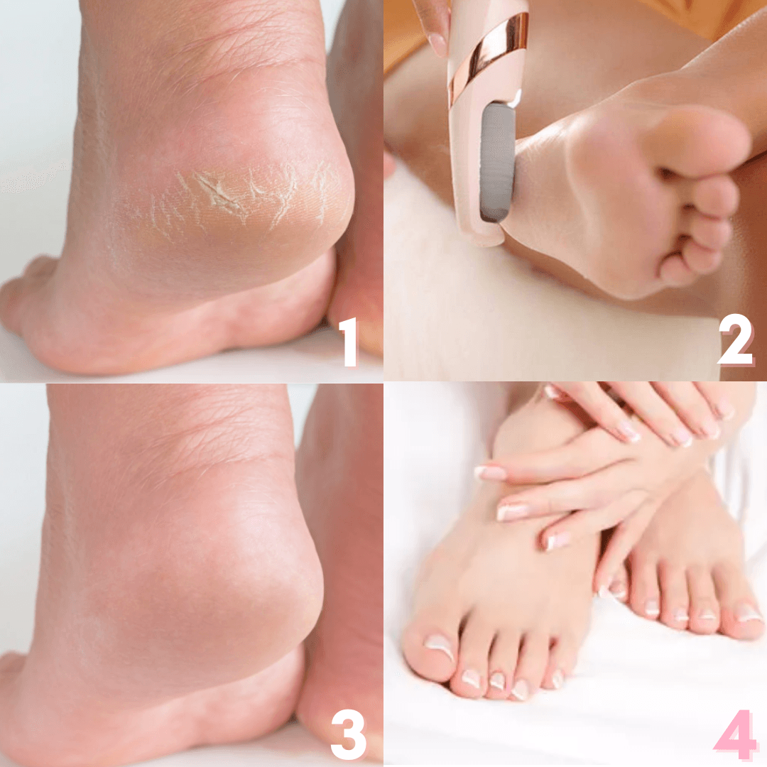 Soft Feet Callus & Crack Remover - Lovitzo