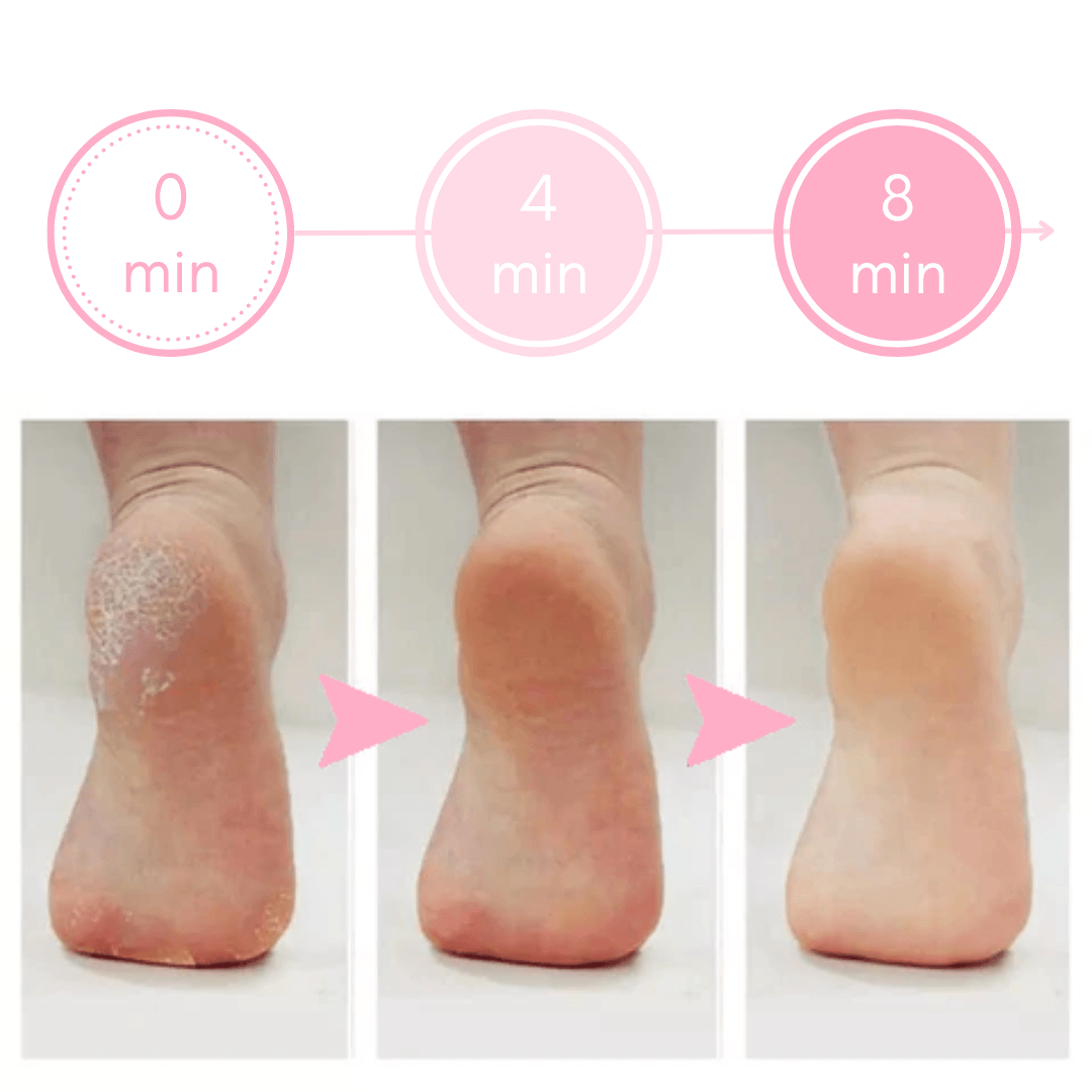 Soft Feet Callus & Crack Remover - Lovitzo