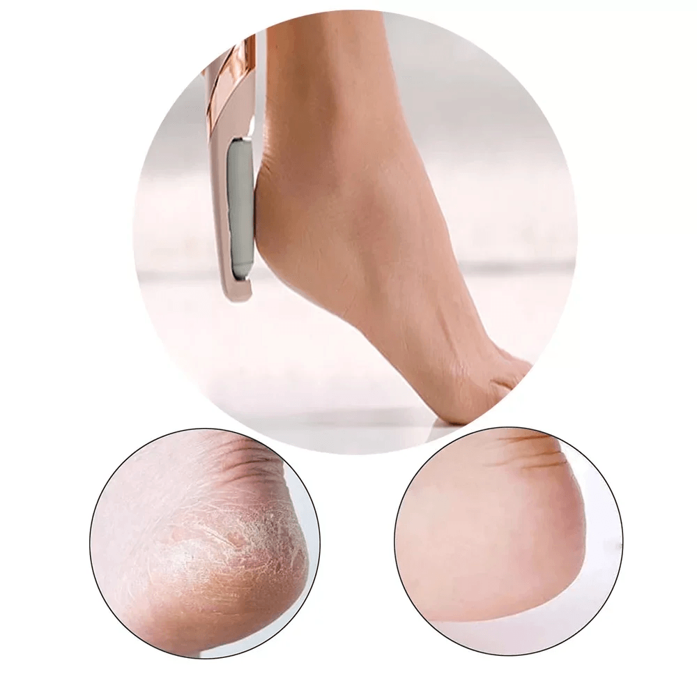 Soft Feet Callus & Crack Remover - Lovitzo
