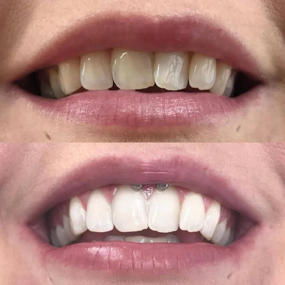 Teeth Whitening Pen - Radiant smile in 10 minutes - Lovitzo