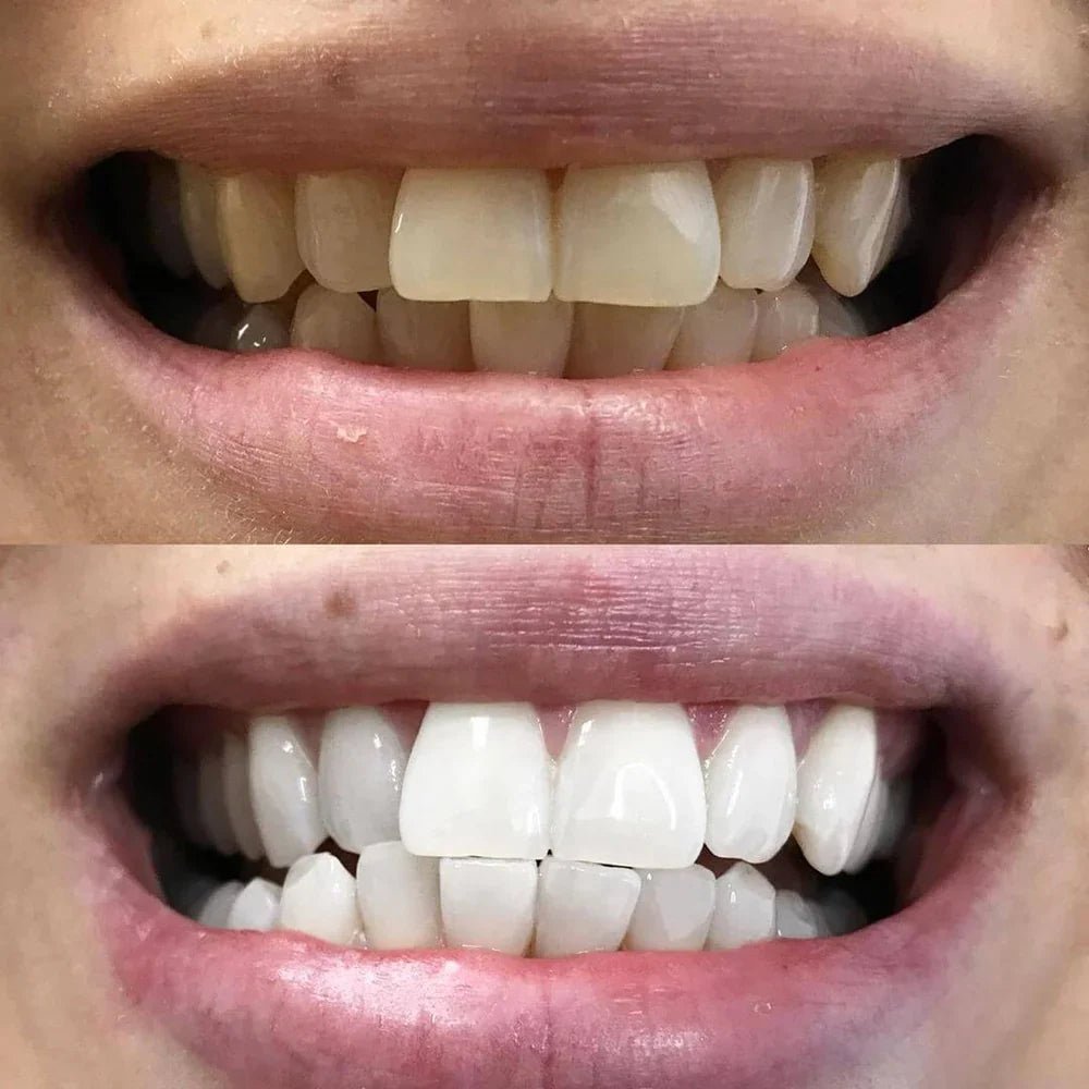 Teeth Whitening Pen - Radiant smile in 10 minutes - Lovitzo