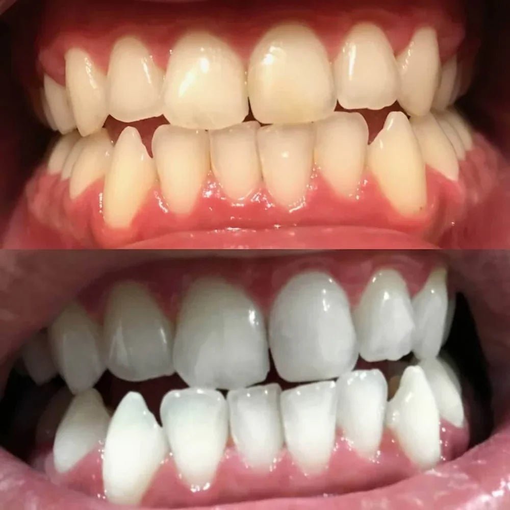 Teeth Whitening Pen - Radiant smile in 10 minutes - Lovitzo